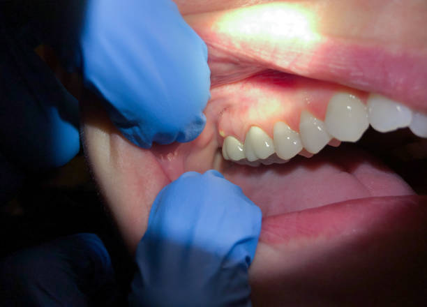 Best Emergency Broken Tooth Repair in Fyffe, AL